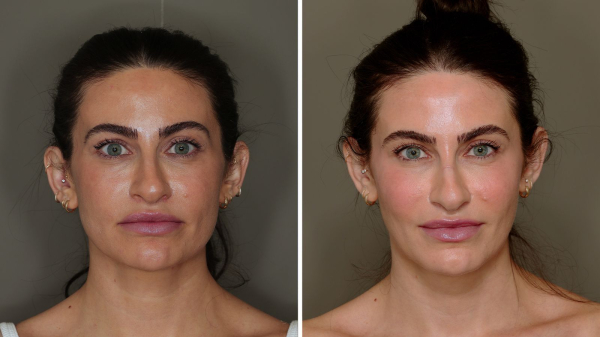 I Tried Facial Fat Grafting—Here’s How I Feel About My Results 2 Years Later